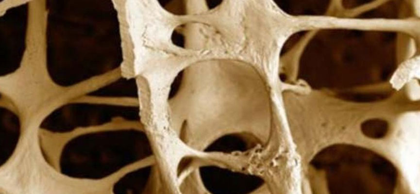 Osteoporosi? Si scopre dal dentista