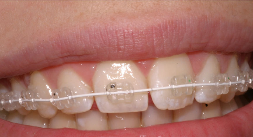 Apparecchio denti fisso in ceramica Milano Bergamo