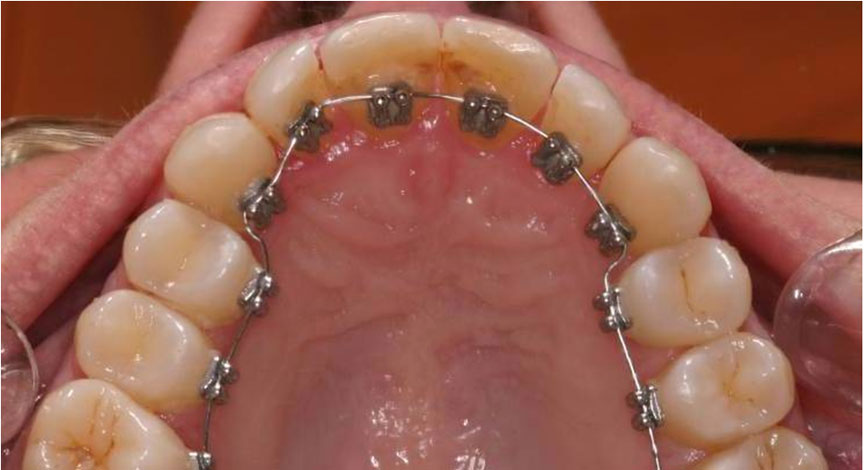 Ortodonzia invisibile linguale